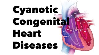 Cyanotic Congenital Heart Diseases  MEDZCOOL [upl. by Eelir]