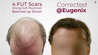 The Ultimate Hair Transplant Challenge A Challenging Hair Restoration Result achieved [upl. by Ashman783]