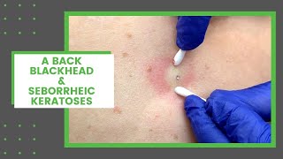 A Back Blackhead amp Seborrheic Keratoses  Dr Derm [upl. by Evey593]