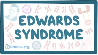 Edwards syndrome  an Osmosis Preview [upl. by Nnylav763]