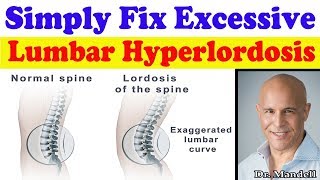 Simply Fix Excessive Lumbar Hyperlordosis  Dr Alan Mandell DC [upl. by Aliet]