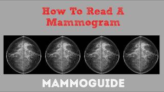 How To Read A Mammogram [upl. by Onairot776]