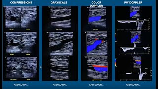 Introduction to Venous Insufficiency Exams [upl. by Yenattirb955]