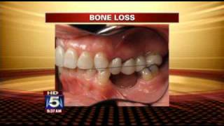 Coping with Tooth Loss [upl. by Bentlee]