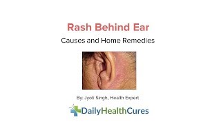 Rash behind Ear 10 Possible Causes and Home Remedies [upl. by Ron309]