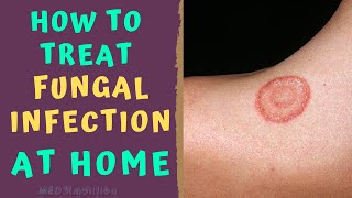 HOW TO TREAT SKIN FUNGAL INFECTION INFECTION AT HOME TINEA RINGWORM REMEDIES HOW TO CURE [upl. by Erinna676]