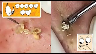 Large Closed Comedones  Whiteheads Extraction [upl. by Oneg397]