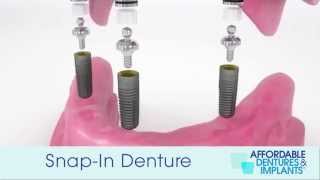 Demo How Do SnapIn Dentures With Implants Work [upl. by Salvatore900]