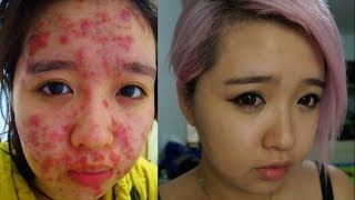 From Severe Acne to Clear Skin [upl. by Dunseath]