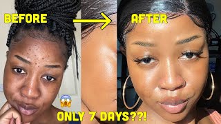 HOW I CLEARED MY SKIN in 1 WEEK and LIGHTENED my dark under eye circles [upl. by Nazay]