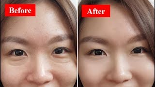 Non Surgical Eye Bag Reduction With Face Yoga [upl. by Aititel979]