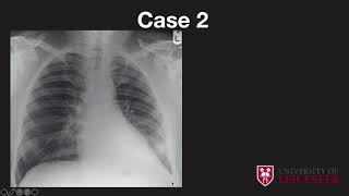 Chest xray case review [upl. by Noyk]