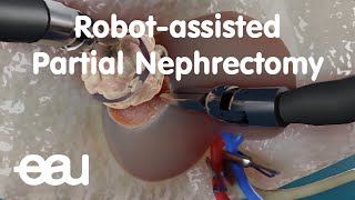 Robotic Partial Nephrectomy Patient Story [upl. by Ricarda]