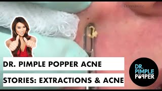 Dr Pimple Popper Acne Stories Extractions amp Acne [upl. by Kcirrek]