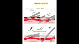 Venipuncture  How to Position a Needle [upl. by Ayidan208]