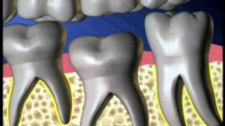 Ankylosis Tooth Oral Surgery [upl. by Dawkins]