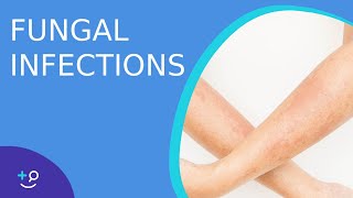 Fungal Infections  Causes Prevention and Cure [upl. by Boot]