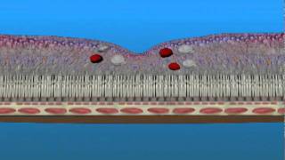 Non Proliferative Diabetic Retinopathy AAO Presentation [upl. by Atisor]