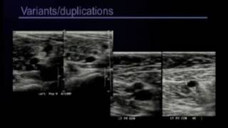 Lower Extremity Venous Doppler [upl. by Euqina]