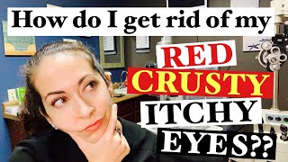 Blepharitis  2 Easy steps to banish red crusty itchy eyes  The Eye Surgeon [upl. by Aneis]