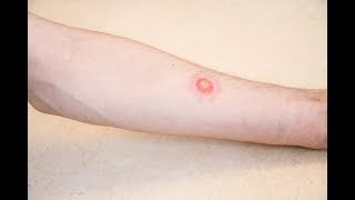 Is it ringworm Signs and symptoms [upl. by Hukill]