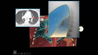 Lateral Chest Radiograph Mediastinal Anatomy [upl. by Haramat]