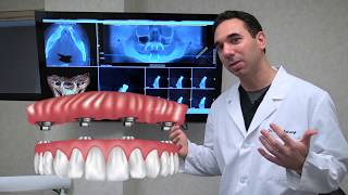 All on 4 Dental Implants Explained [upl. by Quinn]