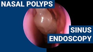 Nasal polyps  PHACON Sinus Patient Meyer [upl. by Adnileb]