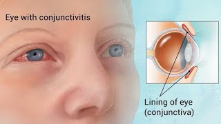 Conjunctivitis  Ophthalmology Videos [upl. by Balliett804]