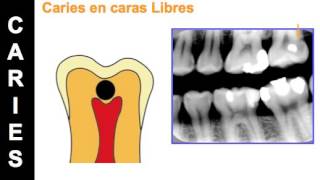 Aspectos Radiograficos de la Caries Dental [upl. by Stanislaus]