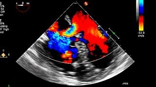 Atrial Septal Defect Primum Echocardiography [upl. by Airemat104]