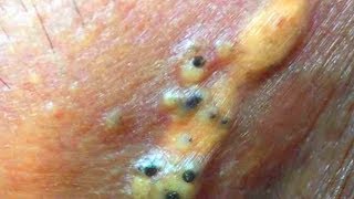 Senile Comedones Blackheads amp Super Blackheads [upl. by Etnovaj]