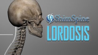 Lordosis [upl. by Killian280]