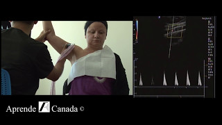 What is Esophageal Manometry [upl. by Notluf]