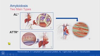 An overview of AL amyloidosis [upl. by Issie]