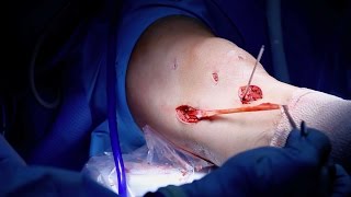 MCL Reconstruction Surgery [upl. by Rraval]